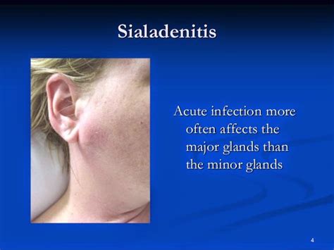 Salivary Gland Infection (Sialadenitis) 